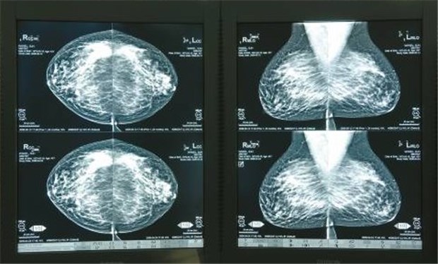 MeVis Medical Solutions Digitale Brustaufnahmen in der MeVis-Software.