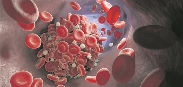 Direkte orale Antikoagulanzien (DOAK) wie Rivaroxaban, Dabigatran oder Apixaban sollten nicht von Personen mit einem nachgewiesenen Antiphospholipid-Syndrom (APS) eingenommen werden, da sie speziell bei dieser Patientengruppe das Risiko für eine thrombembolische Komplikation signifikant erhöhen.