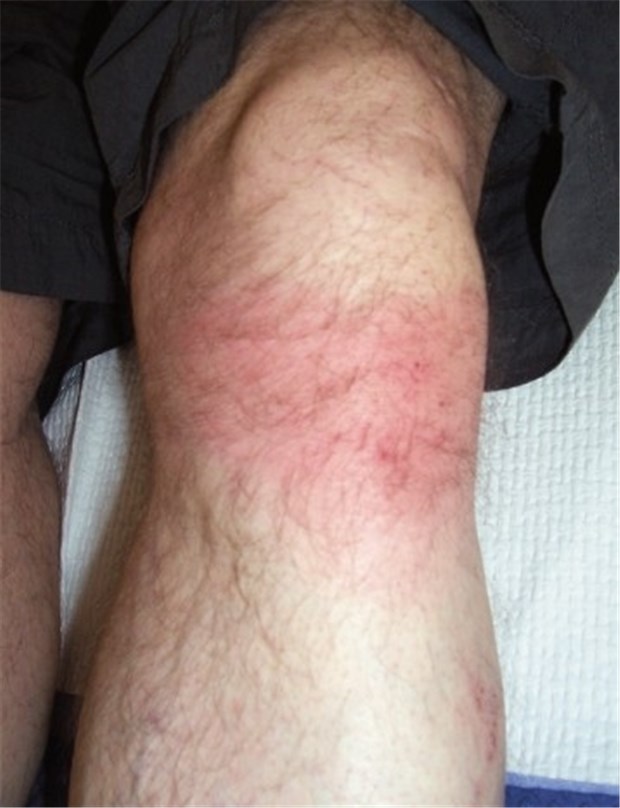 Dickes, rotes Knie - die Ursache war eine Borreliose Diskreter Kniegelenkserguss bei einem Patienten mit Lyme-Borreliose.