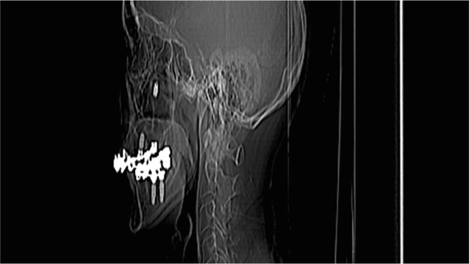 Disloziertes Implantat-Teil im Röntgenbild (Abbildung 4, rechts unten)