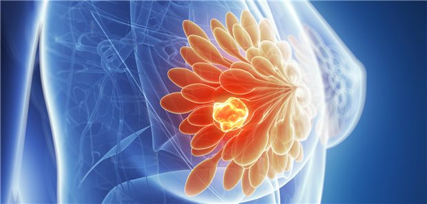 Dr. Zhenzhen Zhang und seine Mitarbeitende resümieren, dass die Studienergebnisse auf ein erhöhtes Sterberisiko für Frauen mit postpartalem Brustkrebs und BRCA-Varianten, vor allem in den fünf bis zehn Jahren nach der letzten Geburt hindeuten.