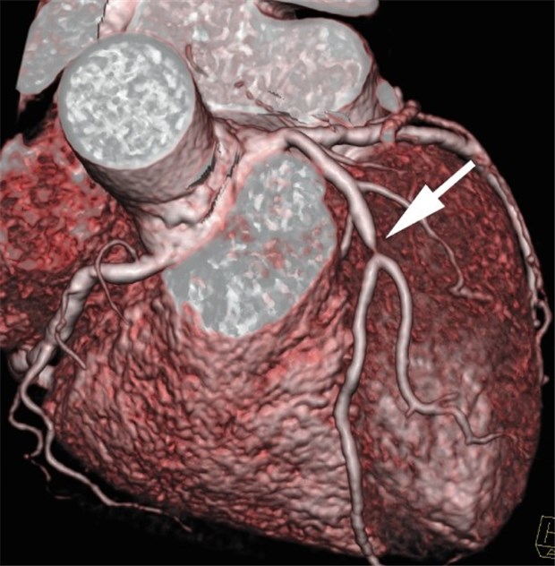 KHK-Therapie ist auch ohne Omega-3-Fettsäuren optimal Dreidimensionales Herz-CT mit Koronarstenose. Eine optimale Therapie kann Gefäßverschlüsse verhindern.