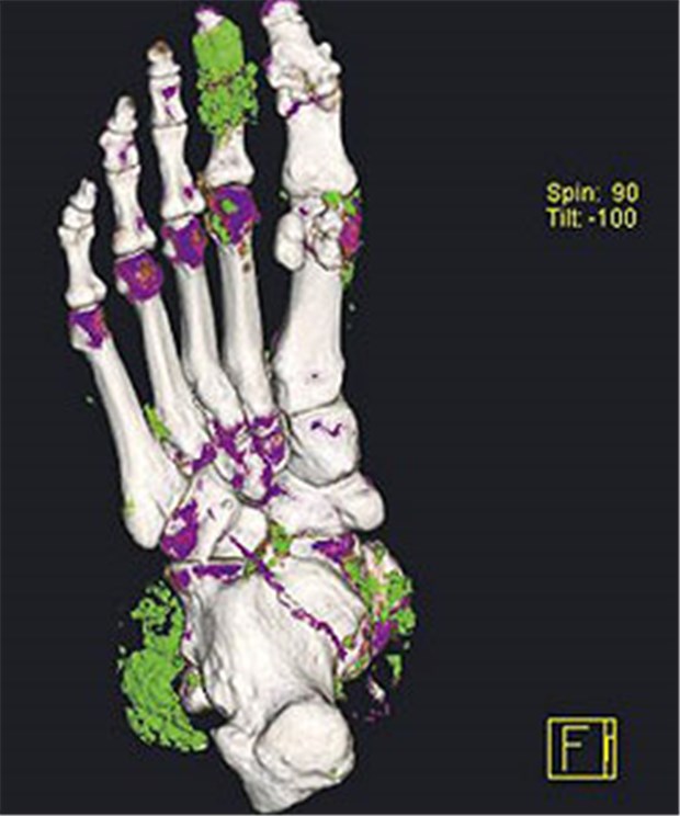 Gicht - eine Systemerkrankung Dual-Energy-CT, Patient mit Arthritis urica, Harnsäureablagerungen grün, Kalzium in verschiedener Dichte grau und violett.