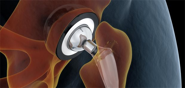 Medically accurate illustration of the hip replacement. 3d illustration.