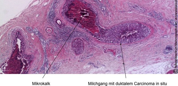 Gefährliche Krebsvorstufen früh erkannt Duktales Carcinom in situ (DCIS): Es handelt es sich um ein nicht-invasives Karzinom, das sich in einem Milchgang ausbreitet und noch nicht in das benachbarte Gewebe eingedrungen ist.