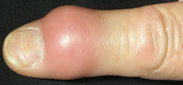 Durch Gicht hervorgerufene Schwellung am distalen Fingergelenk einer 79-jährigen Patientin.