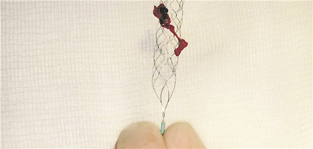 Durch Thrombektomie entferntes Blutgerinnsel.