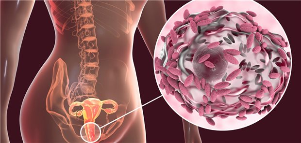 Dreidimensionale gerenderte Illustration einer bakterielle Vaginose bei der Vaginalsekrete Epithelzellen sogenannte Clue-Zellen enthalten, die mit Bakterien Gardnerella vaginalis bedeckt sind.