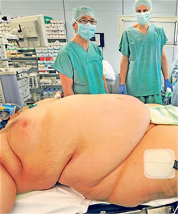 Rheuma-Patienten profitieren von Gewichtsverlust Durch die bariatrische Op wogen die Teilnehmer ein Jahr nach dem Eingriff im Mittel 41kg weniger.