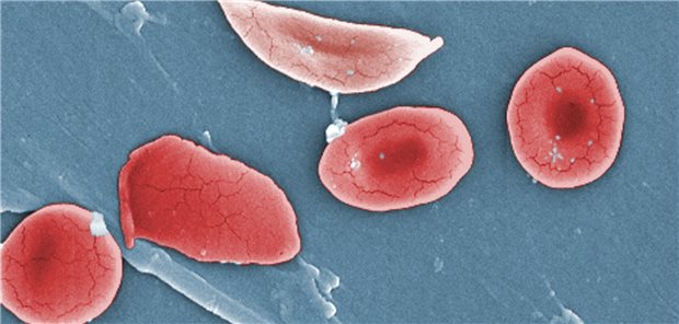Durch eine Mutation im Hämoglobin-S-Gen kommt es bei der Sichelzellkrankheit zur typischen Form der Erythrozyten. Diese führt zu vasookklusiven Krisen und Organschäden. Eine neue Substanz könnte die Häufigkeit dieser Krisen reduzieren.