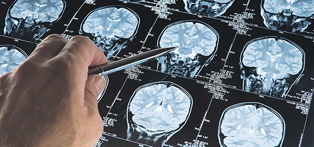 Neue Diagnosekriterien bei Alzheimer Durch neue bildgebende Verfahren ist die Alzheimer-Diagnostik derzeit im Umbruch.