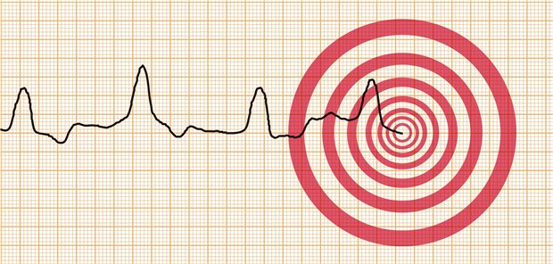 EGK-Linksschenkelblock bei Herzinsuffizienz