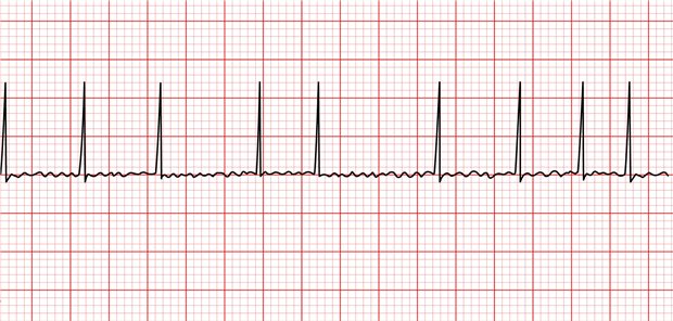EKG bei Vorhofflimmern. Um einer solchen Arrhythmie auf die Spur zu kommen, wird immer wieder die Frage nach dem möglichen Nutzen eines Screenings gestellt.