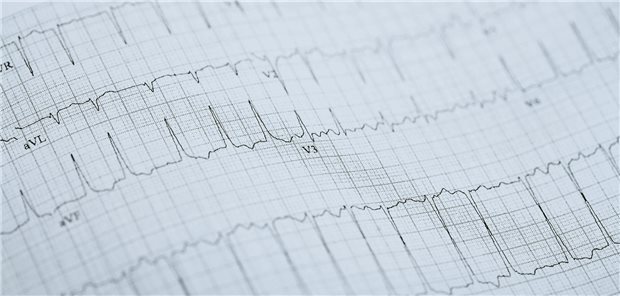 EKG eines Patienten mit Vorhofflimmern-Symptomen