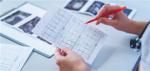EKG wird ausgewertet: Nach einer SARS-CoV-2-Infektion steigt vor allem die Gefahr für Vorhofarrhythmien. (Symbolbild)