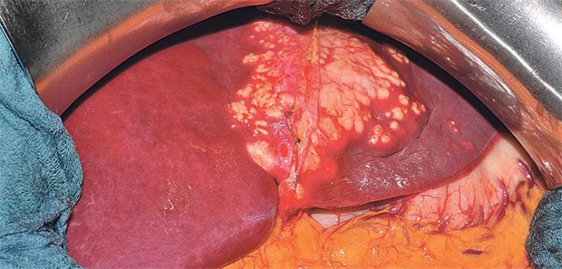Wachsendes Risiko für Leib und Leber Echinokokkose: In der Leber wuchern Larven des Fuchsbandwurms und bilden einen alveolären Tumor.