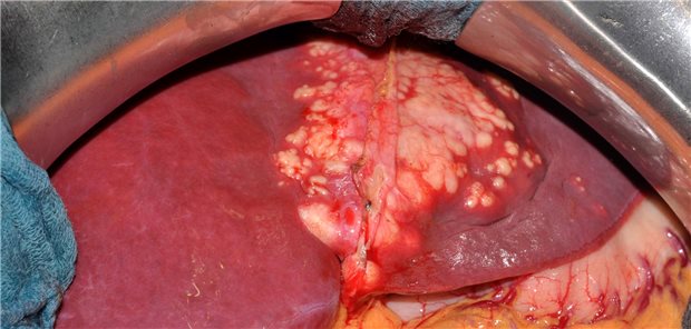 Echinokokkose: In der Leber wuchern die Larven des Fuchsbandwurms.
