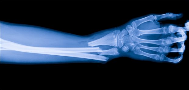 Echter Unterarm im Röntgenbild oder ein durch Künstliche Intelligenz generiertes Bild? Darauf programmierte KI wäre durchaus in der Lage, solche Bilder zu erzeugen – und könnte sogar, wenn ein Röntgenbild der Hand vorliegt, einen anatomisch dazu passenden Unterarm als Bild ergänzen.