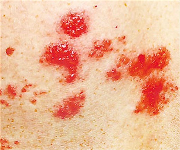 Kombination gegen die Zoster-Neuralgie? Effloreszenzen eines Herpes zoster.