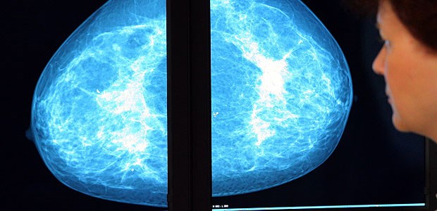 Mammografie-Zoff bald vor Gericht? Eie Ärztin untersucht eine Mammographie.