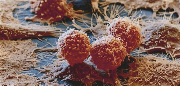 Ein Adenokarzinom in Zellkultur