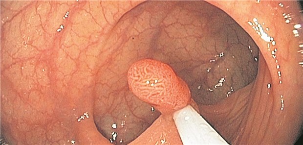 Ein Adenom wird abgetragen: Die Inzidenzrate für ein kolorektales Karzinom betrug bei Patienten mit fortgeschrittenen Adenomen 20 pro 10000 Personenjahre.