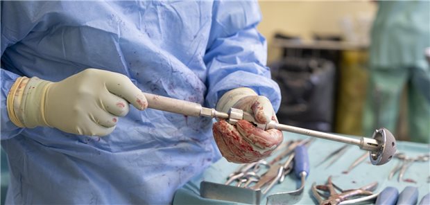 Ein Arzt hält während einer Hüft-OP ein Instrument mit einer montierten künstlichen Hüftpfanne. Je spezialisierter ein Krankenhaus auf eine bestimmte Op ist, desto höher ist die zu erwartende Qualität der Behandlung.