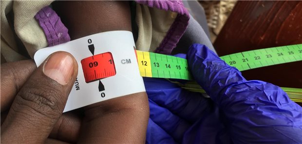 Hunger breitet sich durch Bürgerkrieg im Sudan aus Ein Arzt misst den Armumfang eines unterernährten Babys. Die rote Markierung bedeutet: Das Kind ist schwer unterernährt. Laut der Organisation Ärzte ohne Grenzen sind 30 Prozent der Kinder in Flüchtlingslagern von akuter Unterernährung betroffen.