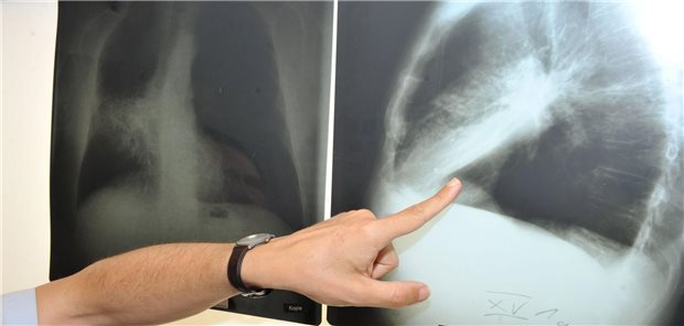 „Nicht übertragbare Krankheiten werden weitgehend ignoriert“ Ein Arzt zeigt auf das Röntgenbild einer von Krebs befallenen Lunge. Rauchen gehört mit zu den Haupttodesursachen in Europa.