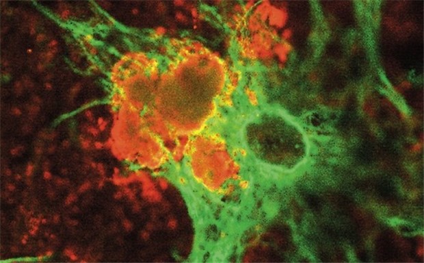 Enzyme und Statine - Intensive Suche nach neuen Arzneien gegen Alzheimer trägt Früchte Ein Astrozyt (grün) vertilgt Alzheimer-Plaques (orange).