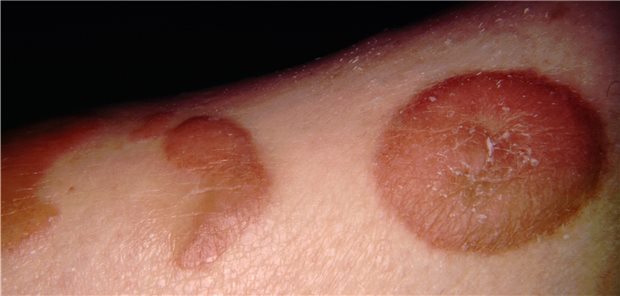 Ein B-Zell-Lymphom am Bein eines 70-jährigen Patienten.