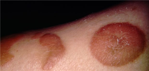 Ein B-Zell-Lymphom am Bein eines 70-jährigen Patienten.