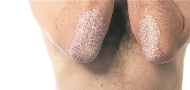 Person mit Schuppenflechte