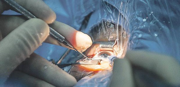 Wettbewerb mit Risiken und Nebenwirkungen Ein Chirurg operiert einen Grauen Star. Die Qualität der Eingriffe in Praxis und Klinik soll vergleichbar werden.