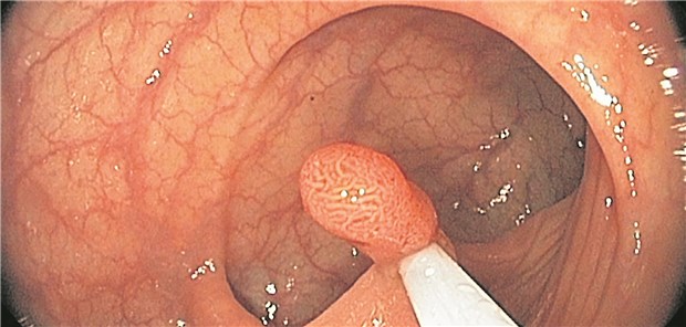 Ein Darmpolyp wird abgetragen. Lassen sich Kolorektaladenome mit ASS verhindern?