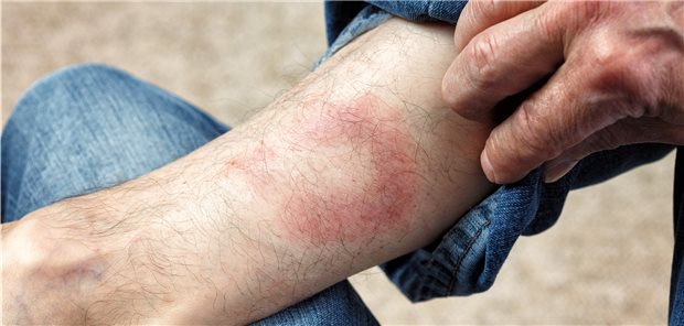 Ein Erythema migrans bestätigt den Verdacht auf Borreliose und rechtfertigt eine Antibiotika-Therapie, unspezifische Symptome und positiver Antikörpertest hingegen nicht.