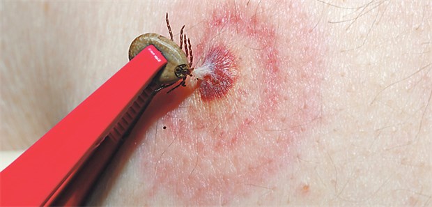 Hinter Hüftschmerz kann Lyme-Arthritis stecken Ein Erythema migrans infolge eines Zeckenstichs ist ein Hinweis auf eine Borreliose. Ohne Antibiotika-Therapie ist das Risiko für Spätfolgen hoch.