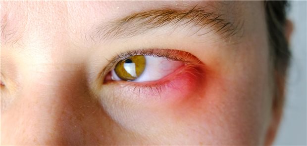 In Nahaufnahme sieht man das stark gerötete Auge einer Frau. 