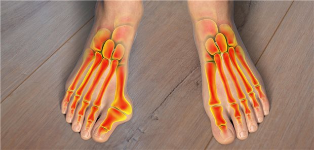 Hallux valgus