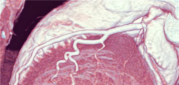 Ein Herz für‘s CT: Wird die radiologische Gefäßdarstellung das neue Mittel der Wahl?