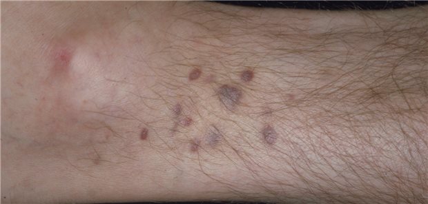 Ein Kaposi-Sarkom am Unterschenkel eines HIV-infizierten Patienten. 