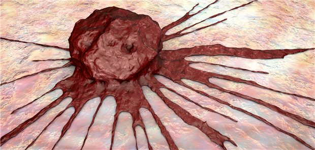 Ein Karzinom: Das umliegende Gewebe dient dem Karzinom unter Umständen wohl als Wachstums-Beschleuniger.