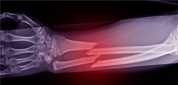 Ein Knochenbruch ist bei Menschen, die an Krebs erkrankt sind, nicht unwahrscheinlich. Das geht aus einer Langzeitanalyse hervor.