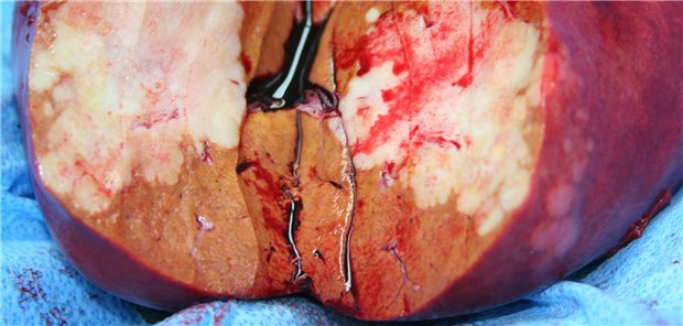 Ein Leberresektat mit einer Lebermetastase