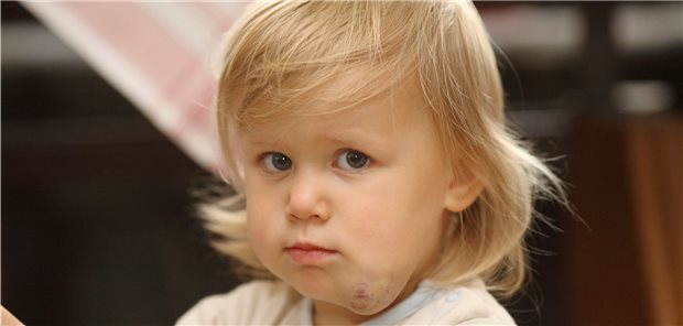 Ein Mädchen mit Blutschwamm am Kinn: Unkomplizierte Fälle heilen in den meisten Fällen von selbst ab. Komplizierte können als Kassenleistung medikamentös behandelt werden.