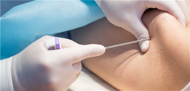 Ein Onkologe punktiert das Ilium eines Patienten, um das Knochenmark auf Leukämie zu untersuchen.