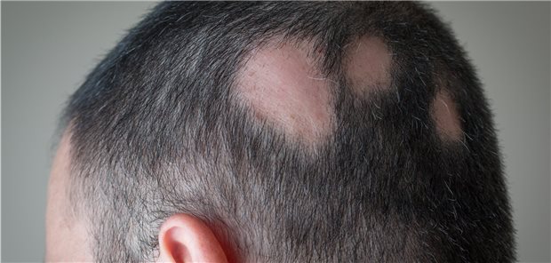 Ein Patient mit Alopecia areata. 