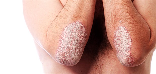 Ungleiche Versorgung bei Schuppenflechte Ein Patient mit Psoriasis: Ärzte bemängeln, dass es starke regionale Unterschiede in der medikamentösen Therapie gibt.