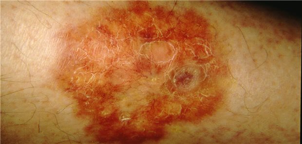 Ein Patient mit der Hauterkrankung Necrobiosis lipoidica. In den USA laufen derzeit Studien mit verschiedenen Medikamenten.

