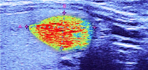 Ein Schilddrüsenknoten im Ultraschall. Dieser scheint noch annähernd rund.